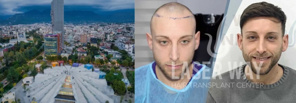 Trapianto Capelli Tirana