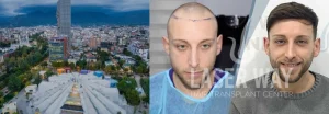 Trapianto Capelli Tirana